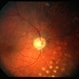 Proliferative Diabetic Retinopathy (PDR), PRP, Regressed NV